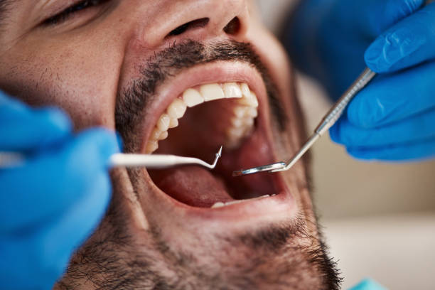 Best Urgent Care for Lost Fillings or Crowns in Clarksburg, MD