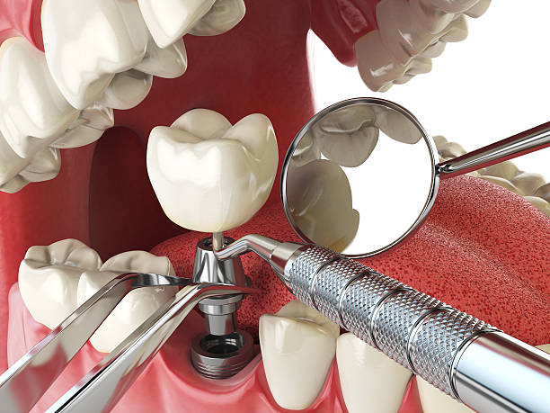 Best Emergency Tooth Extraction in Clarksburg, MD
